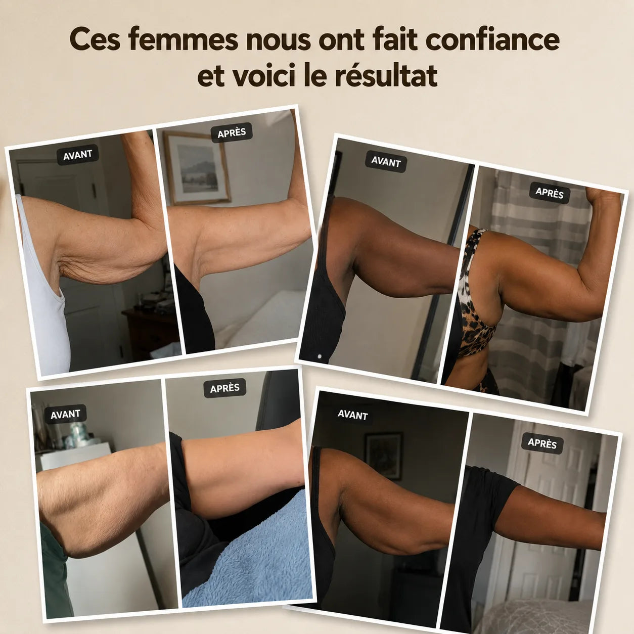 Résultats avant/après de la Manchette Belnya